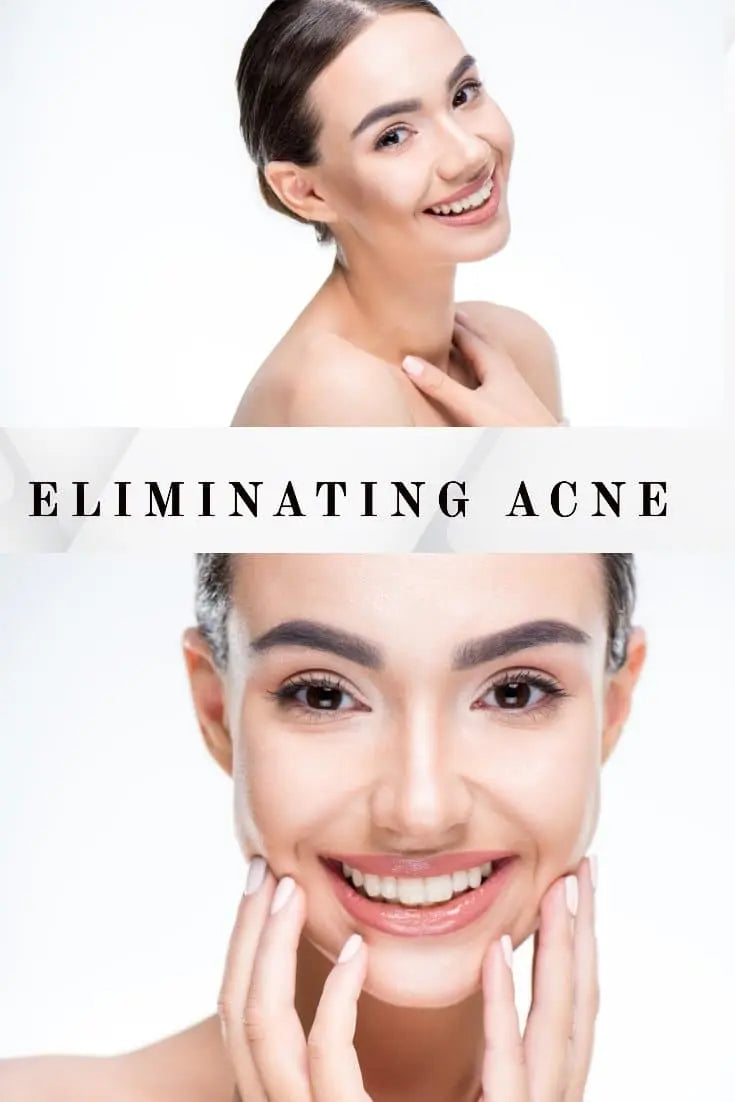 How to get Rid of Acne Eliminating Acne CE digital downloads